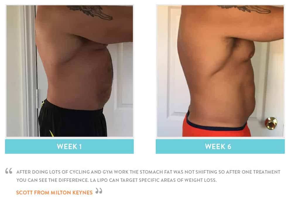 Before & After Stomach Fat Falkirk