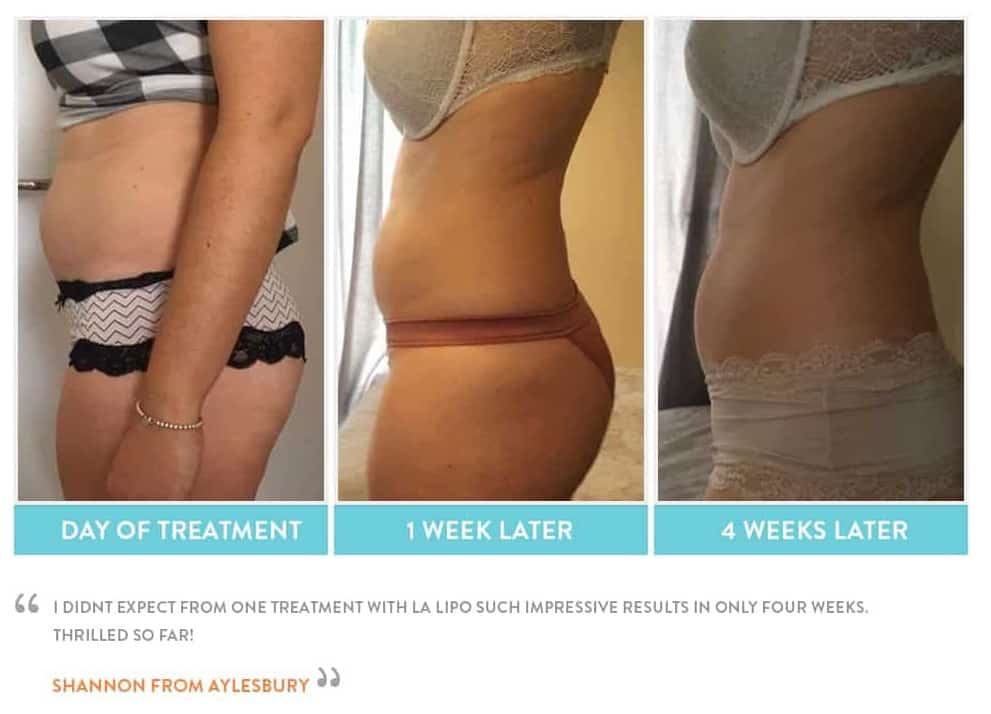 before, Cryolipolysis Falkirk