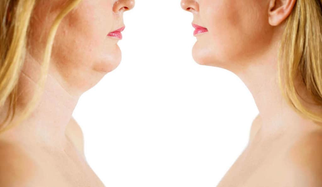 Double Chin treatment Falkirk before and after results