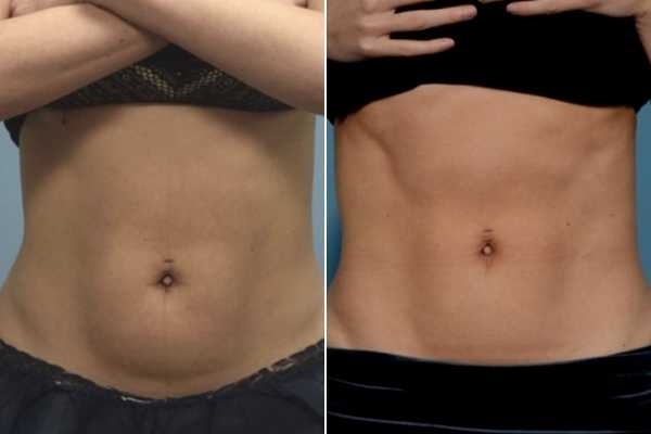 body sculpting FAQs Falkirk