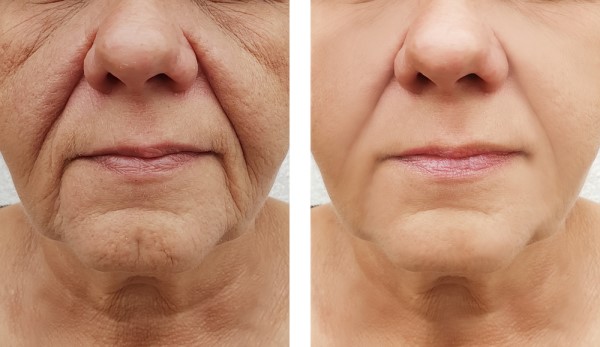 Learn more about Morpheus8 Treatment Falkirk today!
