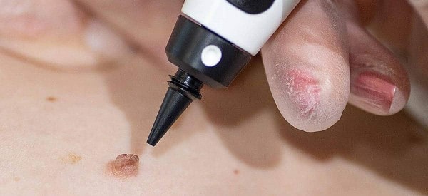 After Skin Tag Removal Falkirk