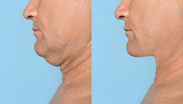 Which Non-Surgical Treatments Work Best for Jowls and Loose Skin Falkirk?