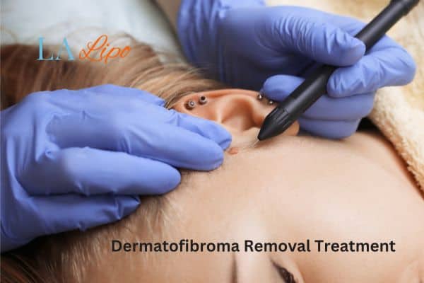 Dermatofibroma Removal Treatment Falkirk