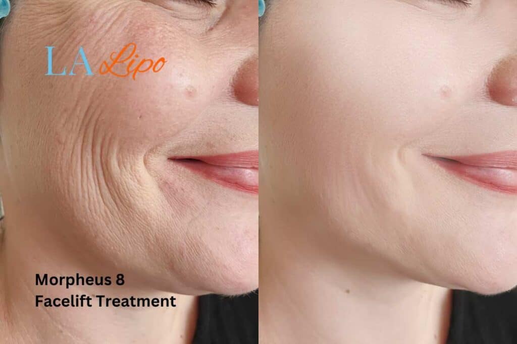 Morpheus8 Treatment Falkirk for flawless skin! Call us today!