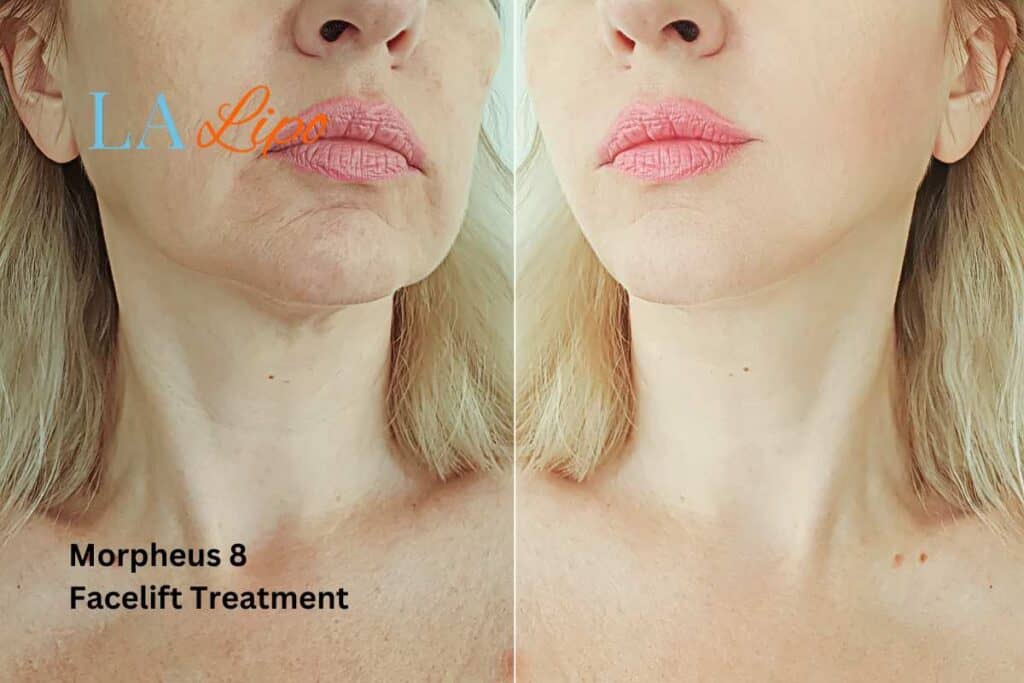 Turn back time with Morpheus8 Treatment Falkirk