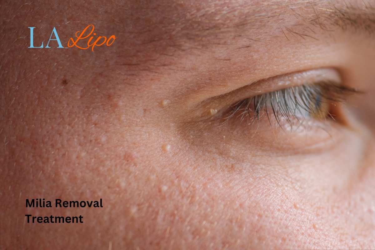 Cryopen Milia Removal: Is It the Easiest and Safest Option Falkirk?