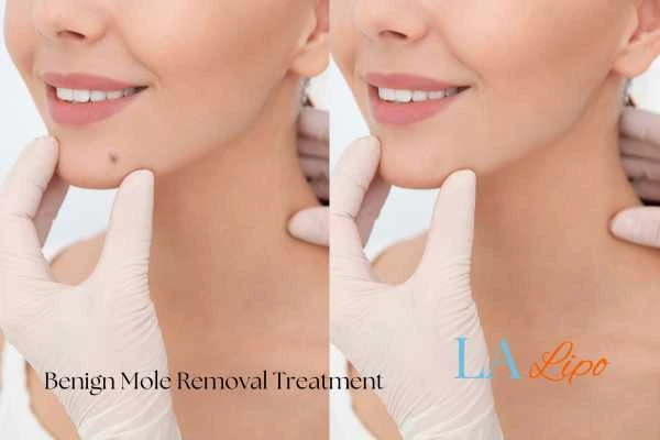 Before-and-after results following benign mole-removal treatment Falkirk