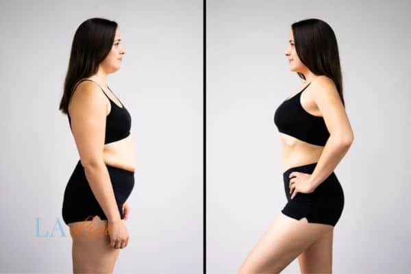 image of woman before and after results of LA-EMS Body Sculpting Falkirk to help treat Diastasis recti