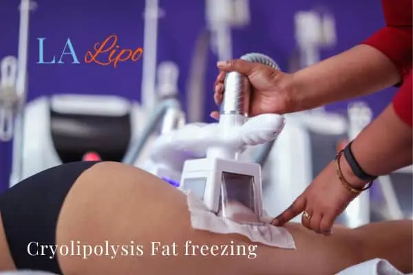 women getting fat freezing Falkirk