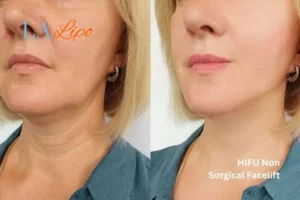 hi-fu for wrinkles Falkirk before and after results