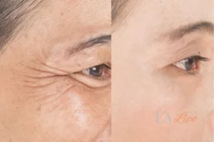 Before and after results of woman - HI-fu wrinkles reduction treatment Falkirk