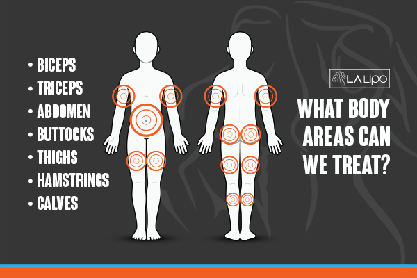 Graphic to show areas you can have LA-EMS Body Sculpting Falkirk treatment.