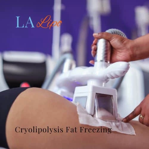 fat freezing - Cryolipolysis Falkirk