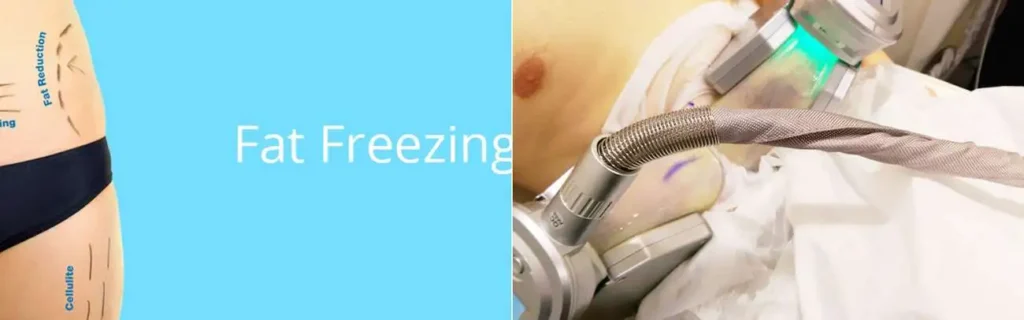 Fat freezing Falkirk on multiple areas of the body