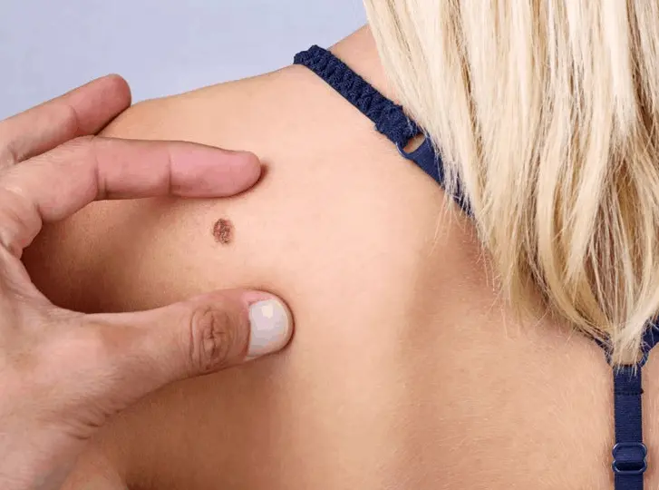 woman having mole removal Falkirk consultation before treatment.