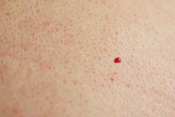 close up of a cherry angioma Falkirk