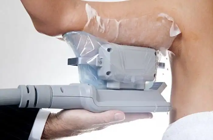 Picture of fat freezing Falkirk on the upper arms.