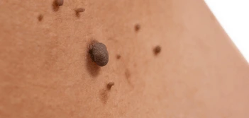 image of a skin tag Falkirk