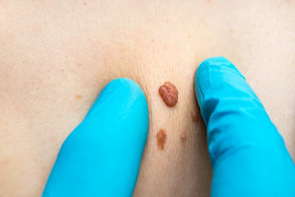 Consultant examining a skin tag Falkirk