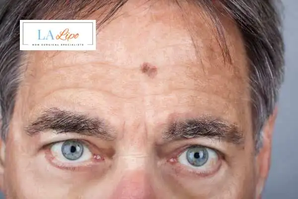 Solar Lentigo Removal Falkirk image of man with mark on his forehead