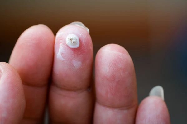 wart on person finger - cryotherapy to treat from LA LIPO Falkirk