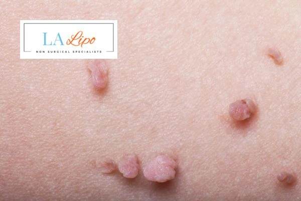 Does cryopen skin tag removal Falkirk hurt? Find out now call our team today!
