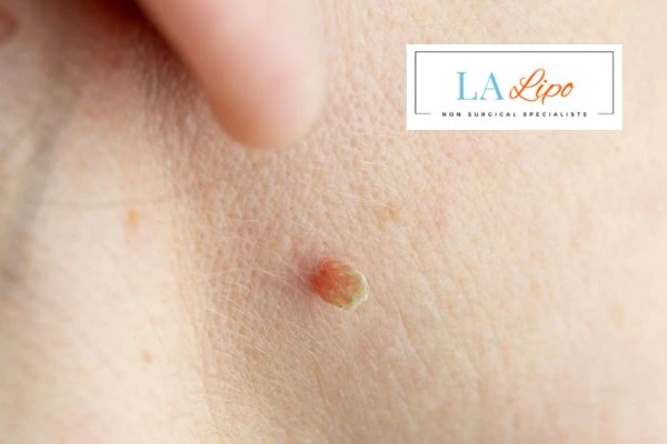 Book skin tag removal Falkirk today speak to our team now!