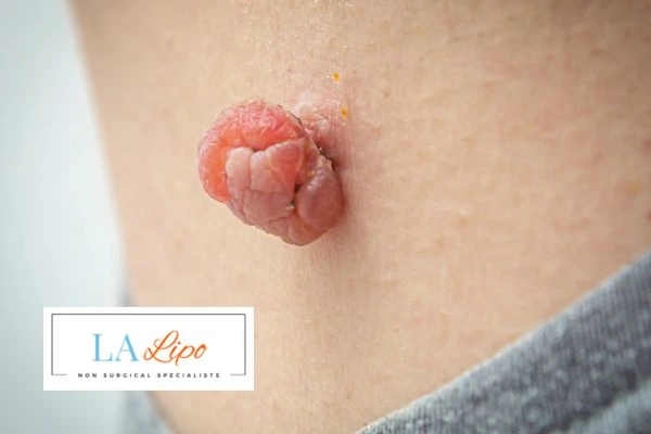 Interested in skin tag removal Falkirk? Concerned about the pain? Find out more today!