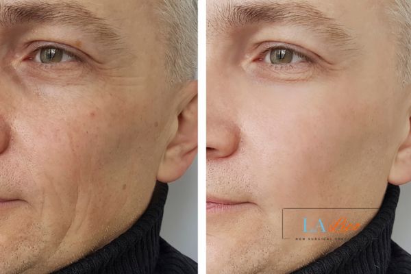 See the amazing results of Morpheus8 Treatment Falkirk!