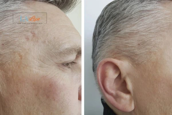 Mens Before & After Morpheus 8 Results Falkirk