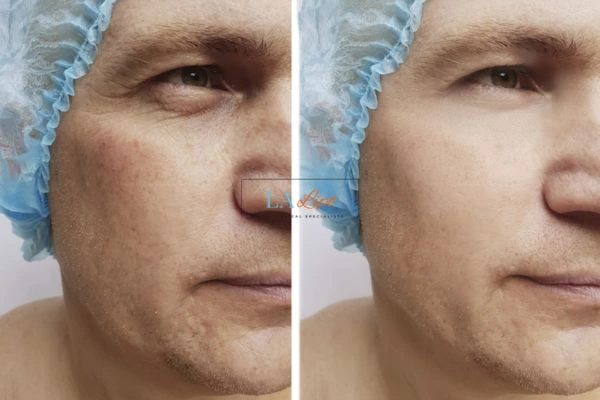 Before and after Morpheus 8 Results Falkirk