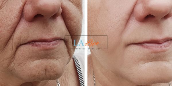 Older lady deeper wrinkle reduction - LA LIPO Morpheus 8 Results Falkirk