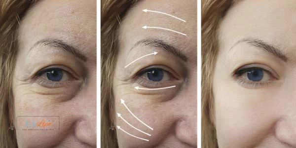 Amazing eye lift Morpheus 8 results Falkirk