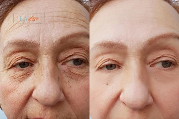 The powerful benefits of Morpheus8 Treatment Falkirk - Call Our team today!