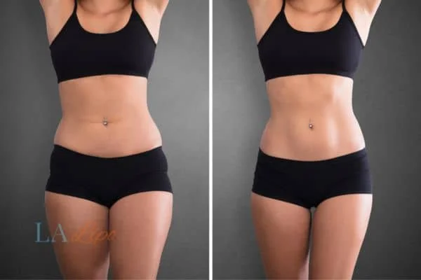 before and after results of non-surgical treatment to help a woman's body image and mental health Falkirk