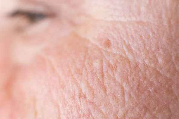 close up picture of a woman's face showing an age spot Falkirk