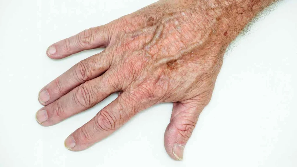 Male hand showing age spot Falkirk