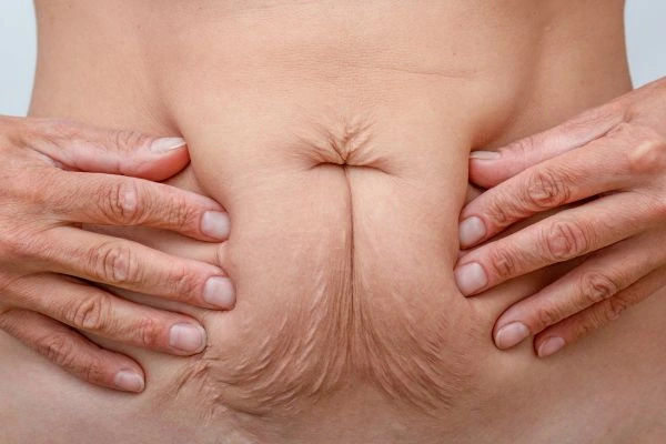Image of a woman's stomach with loose skin - example of skin tightening Falkirk options