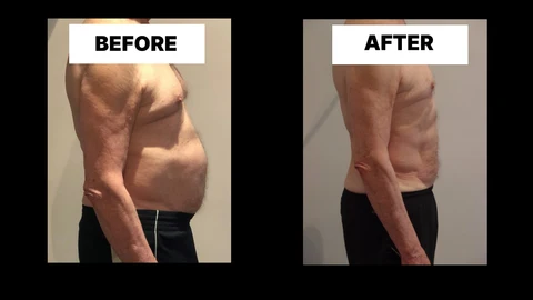 What Symptoms Can Diastasis Recti Cause in Men? Weak Core, Back Pain and Poor Posture Falkirk